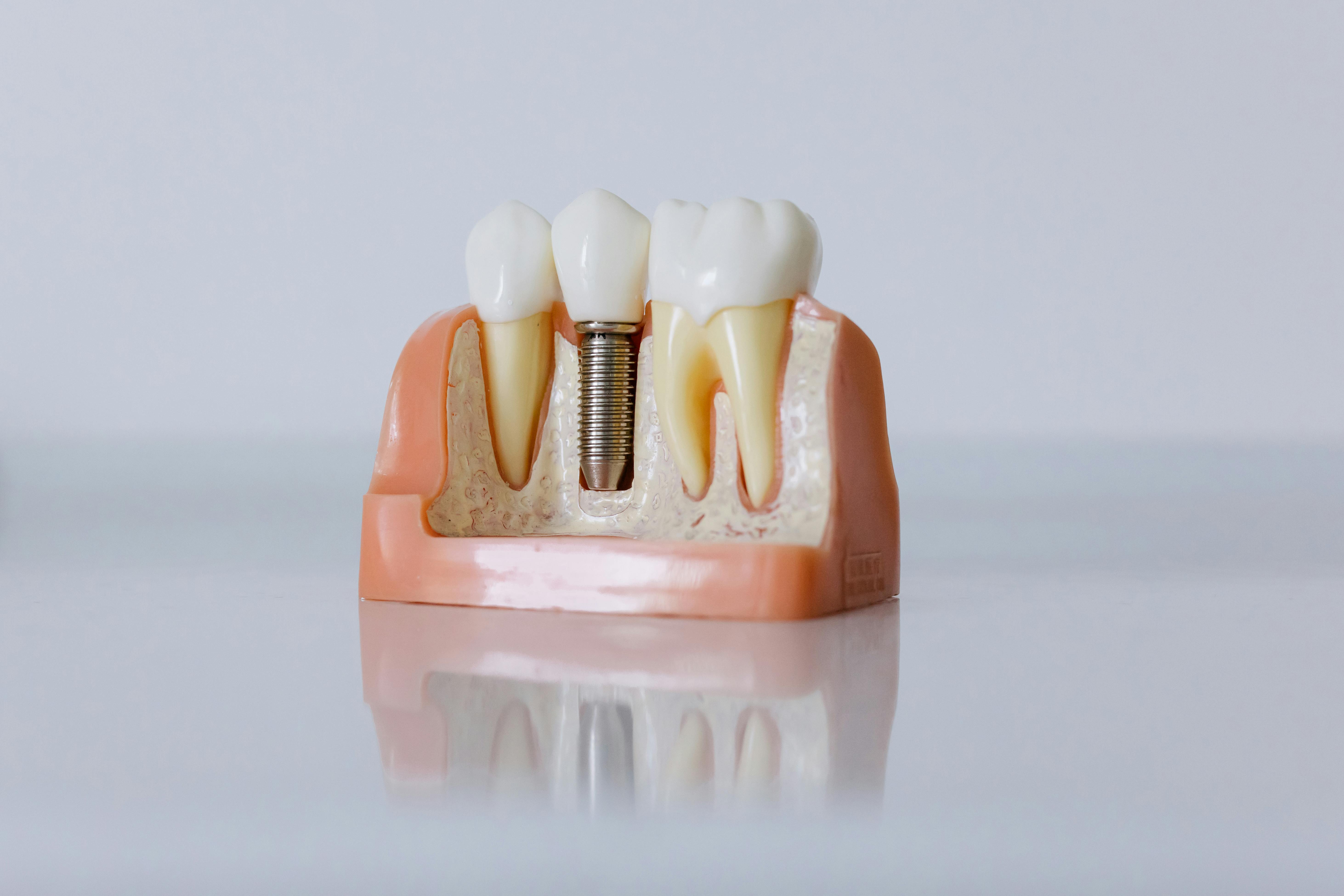 Dental Implants